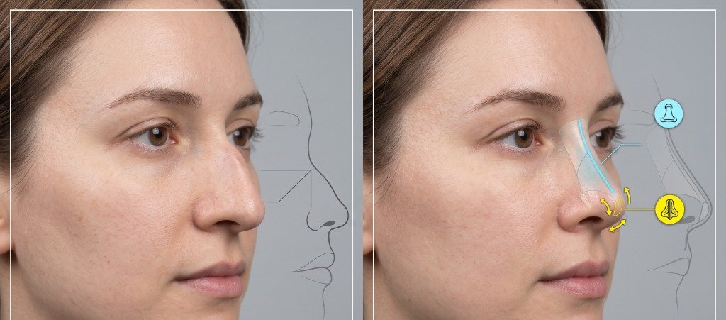 Structural & Preservation Rhinoplasty